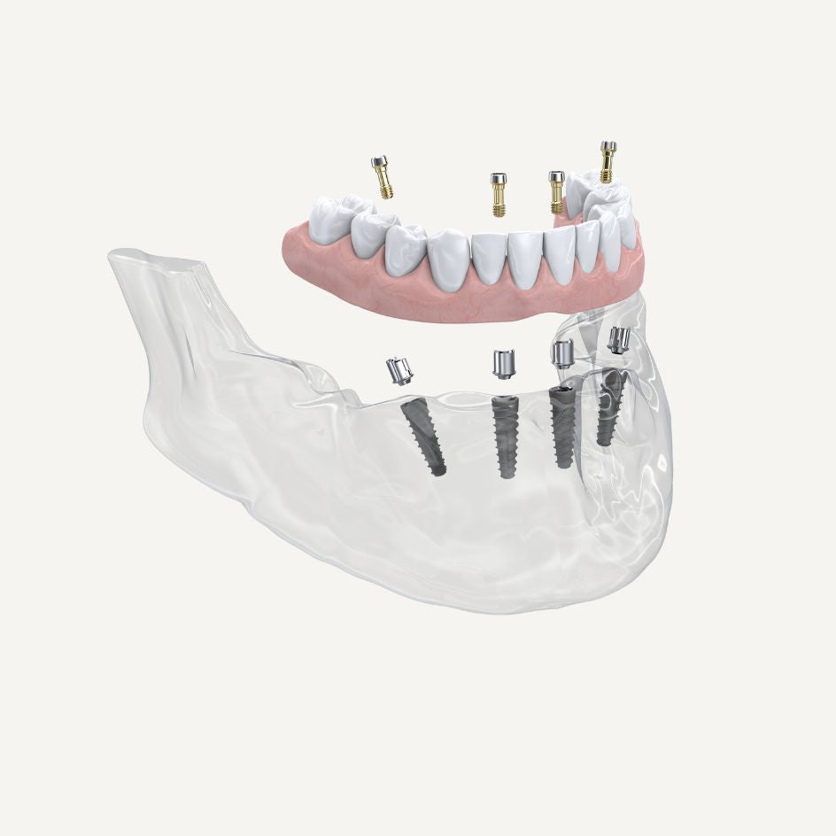 NeoBase® Abutment Angulated Screw Channel